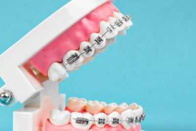 7 Smart Tips to Lower Your Braces Cost in Sydney